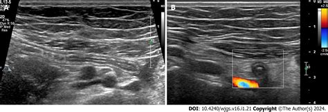 Added value of ratio of cross diameters of the appendix in ultrasound diagnosis of acute ...