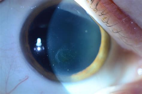 What Is Corneal Erosion Syndrome at Theresa Hanson blog