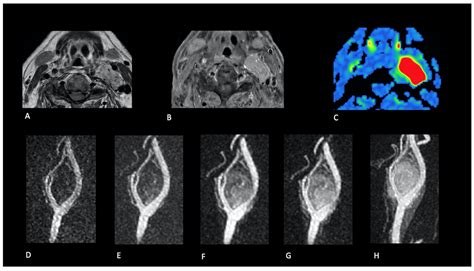 Role of Pseudo-Continuous Arterial Spin Labeling and 4D MR Angiography ...