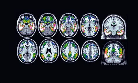 Tau Positron Emission Tomography Breakthrough in Predicting Dementia in ...