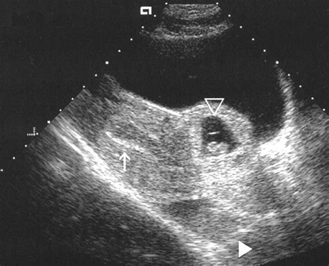 Placenta Percreta Ultrasound