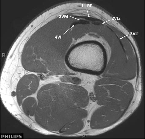 A new look at quadriceps tendon – Is it really composed of three layers? - The Knee
