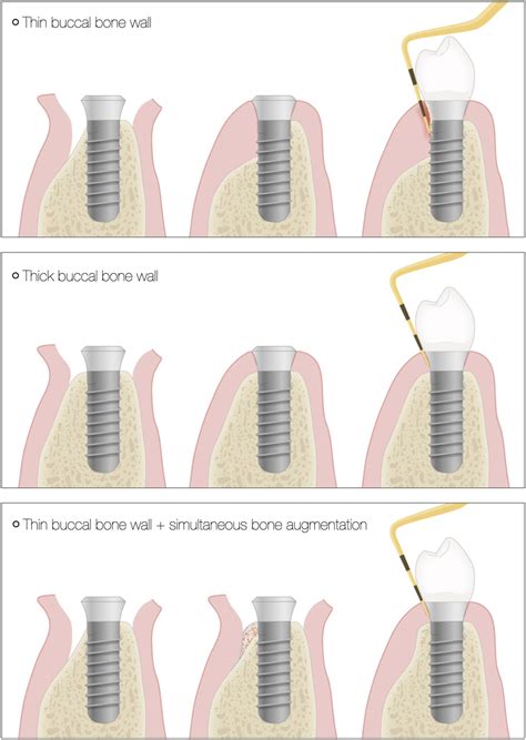 Influence of buccal bone wall thickness on the peri‐implant hard and ...
