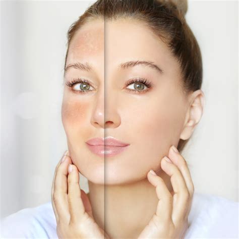 Top Dark Spot Reduction Treatments in Vienna Virginia - Top Plastic Surgeon In McLean, VA