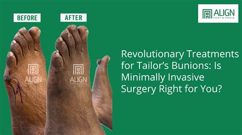 Revolutionary Treatments for Tailor’s Bunions: Is Minimally Invasive Surgery Right for You ...