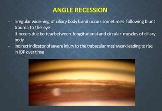 Angle Recession 的图像结果