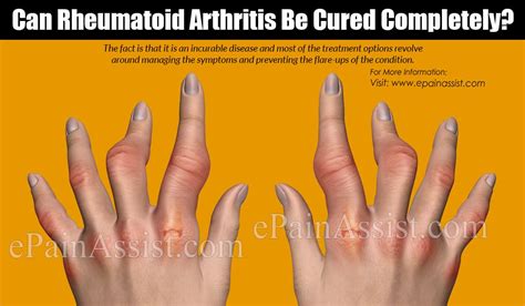 Can Rheumatoid Arthritis Be Cured Completely?|Treatment Options For ...