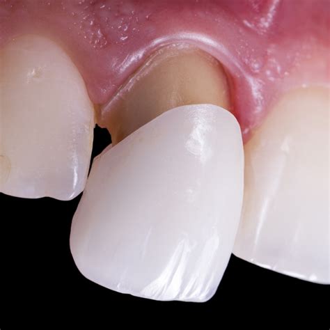 Alternative Zu Veneers at Carlos Pratt blog