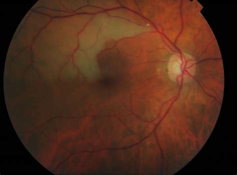 Retinal artery occlusion causes, symptoms, diagnosis, treatment & prognosis