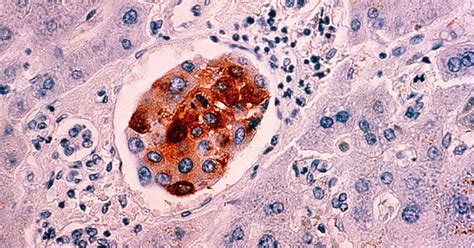 Roche’s evERA Giredestrant Study Hits In All-Comer Breast Cancer Population
