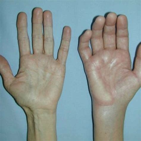 Chronic Regional Pain Syndrome