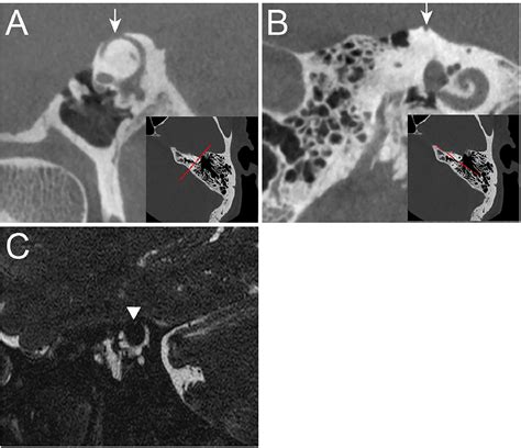 Radiologic evaluation of conductive hearing loss - Operative Techniques in Otolaryngology-Head ...