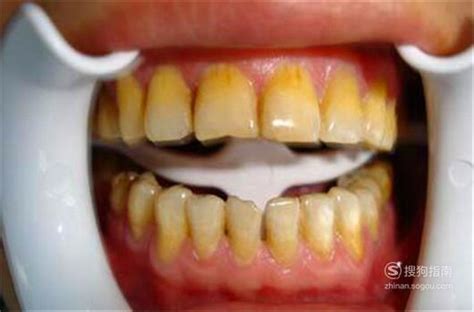 牙龈出血怎么办?舒适达帮你有效改善|牙龈|出血-综合资讯-川北在线
