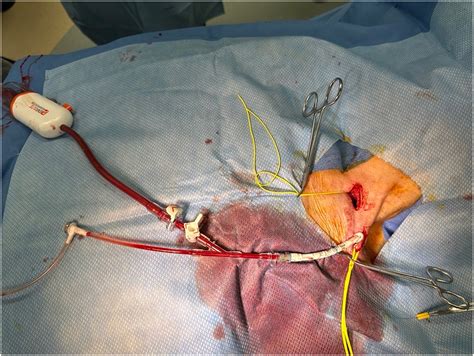 Transcarotid Artery Revascularization via Carotid-Subclavian Bypass - Journal of Vascular Surgery