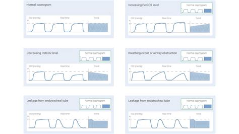 Basic waveform capnography as a continuous monitoring tool during mechanical ventilation ...