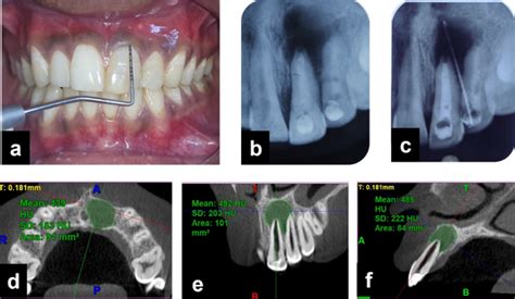 Surgical treatment of apico-marginal defect associated with maxillary ...
