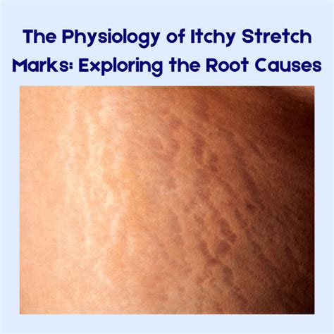 Understanding Why Stretch Marks Itch | Clinikally