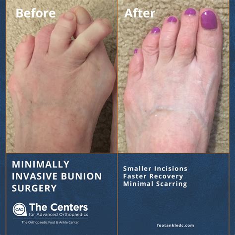 Foot Bunion Surgery Before And After at Hamish Geake blog