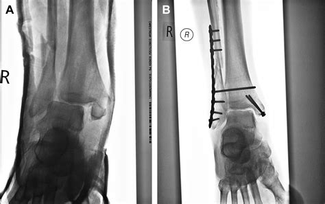 Syndesmosis Stabilisation: Screws Versus Flexible Fixation - Foot and ...