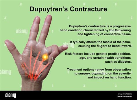 A 3D medical illustration displaying a patient's hand with Dupuytren's ...