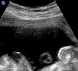 Bildergebnis für 2 vessel umbilical cord ultrasound