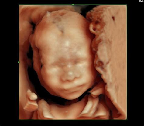 Fetal Medicine Department in Anand - Gujarat
