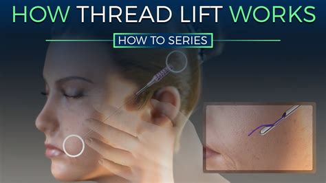 Image result for Thread Lift Procedure YouTube