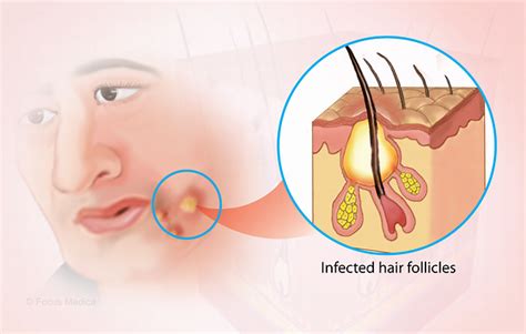 Image result for Removing Carbuncle