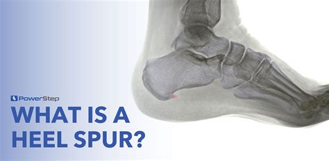 Metatarsal Bone Spur Treatment