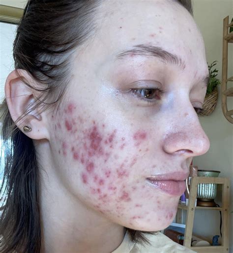 Image result for Claravis Compounding Powder