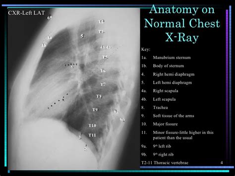 Image result for Chest X-Ray Tutorial