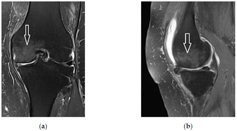 Tissue Integration of Calcium Phosphate Compound after Subchondroplasty ...