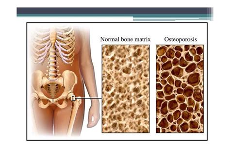 Osteoporosis, Osteomalacia, Paget's disease | PDF