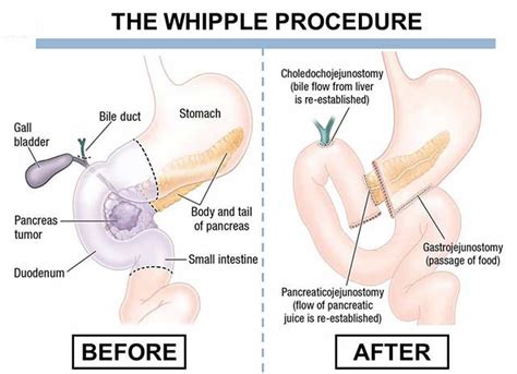 Whipple procedure steps, indications, complications, recovery ...
