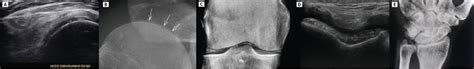 Polymyalgia rheumatica – Was suchen? Wie behandeln? - Allgemeine Innere ...