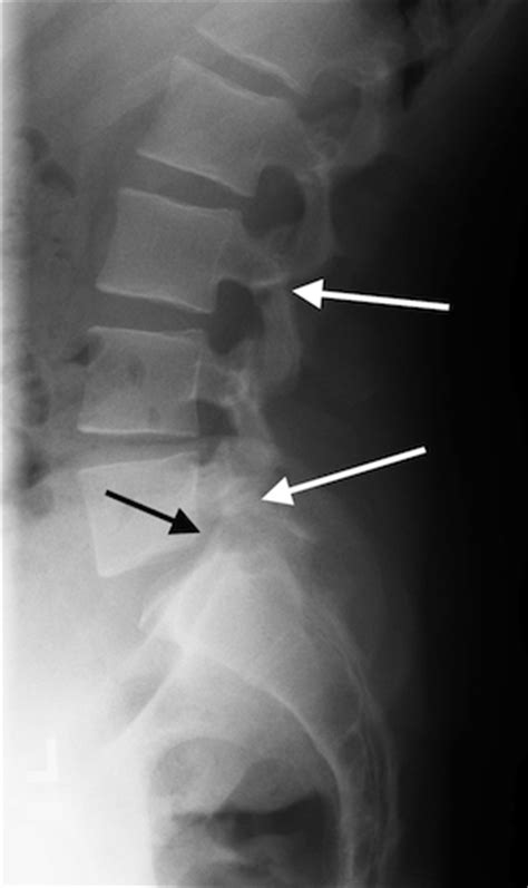Kuvatulokset haulle pars fracture treatment