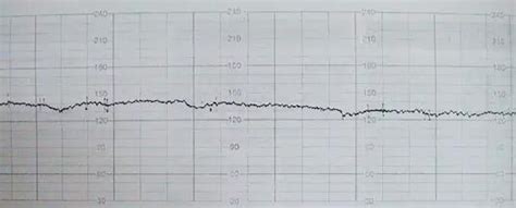 胎心监护报告图解析：胎儿监护中各类型减速的特点_凤凰网健康_凤凰网