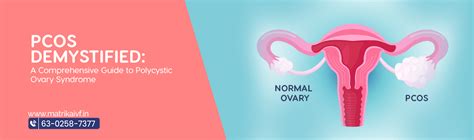 Causes & Symptoms of pcos (Polycystic ovary syndrome)- MatrikaIVF