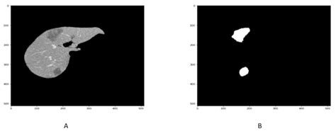 Segmentation of Liver Tumor in CT Scan Using ResU-Net