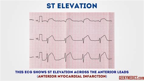 How to Read an ECG | ECG Interpretation | Geeky Medics