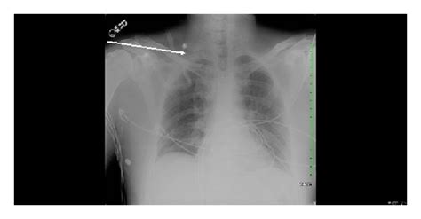 Image result for First Rib Resection Surgery