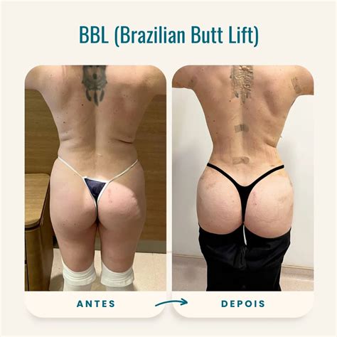 Kim Kardashian Cirurgia Plastica De Bunda Antes E Depois