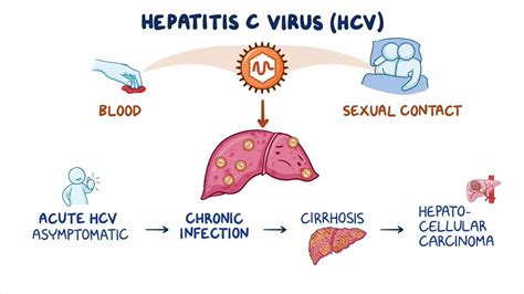 Hepatitis C: Video & Meaning | Osmosis