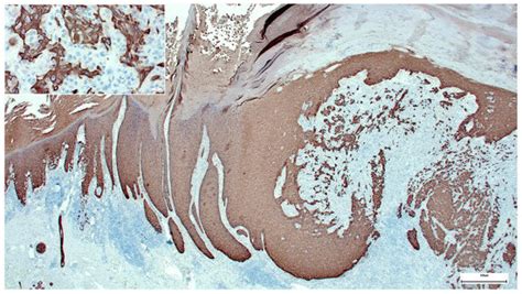 A Wolf in Sheep’s Clothing: Collision of Melanoma and Keratoacanthoma