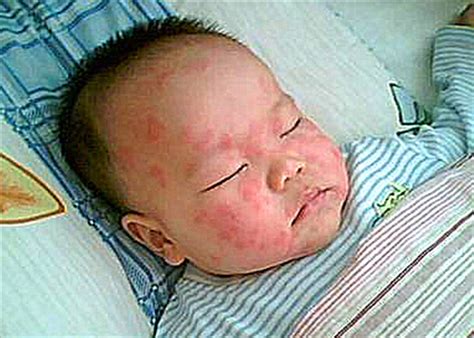 荨麻疹的症状图片-荨麻疹图片大全-荨麻疹-39疾病百科
