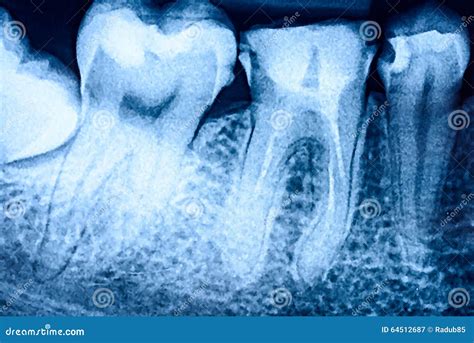 Tooth Decay on X-Ray stock image. Image of health, care - 64512687