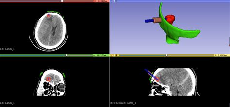 外伤性脑疝应用3D技术个体化治疗一例