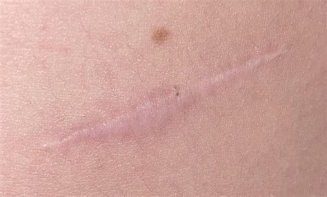 Melanoma