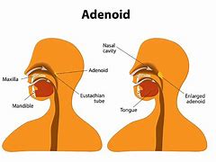 adenoids 的图像结果