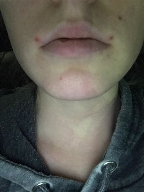 Breaking Out Around Mouth